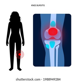 Knee bursitis inflammation. Inflamed bursa in human leg. Patella, kneecap disease, pain and deformity. Diagnosis and injection treatment. Anatomical musculoskeletal poster, medical vector illustration