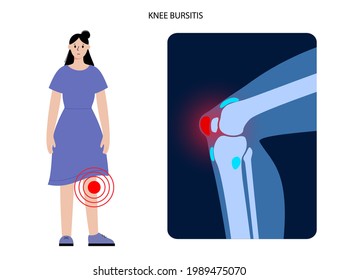 Knee bursitis inflammation. Inflamed bursa in human leg. Patella, kneecap disease, pain and deformity. Diagnosis and injection treatment. Anatomical musculoskeletal poster, medical vector illustration