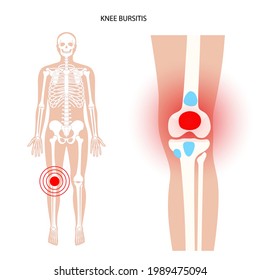 Knee bursitis inflammation. Inflamed bursa in human leg. Patella, kneecap disease, pain and deformity. Diagnosis and injection treatment. Anatomical musculoskeletal poster, medical vector illustration