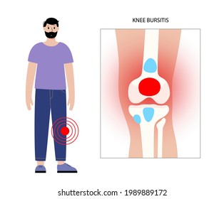 Knee bursitis inflammation. Inflamed bursa in human leg. Patella, kneecap disease, pain and deformity. Diagnosis and injection treatment. Anatomical musculoskeletal poster, medical vector illustration