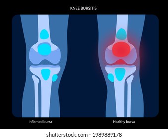 Knee bursitis inflammation. Inflamed bursa in human leg. Patella, kneecap disease, pain and deformity. Diagnosis and injection treatment. Anatomical musculoskeletal poster, medical vector illustration