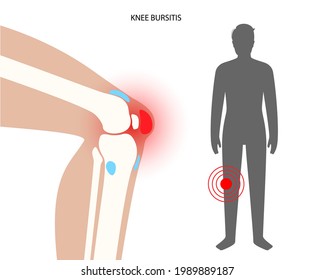 Knee bursitis inflammation. Inflamed bursa in human leg. Patella, kneecap disease, pain and deformity. Diagnosis and injection treatment. Anatomical musculoskeletal poster, medical vector illustration