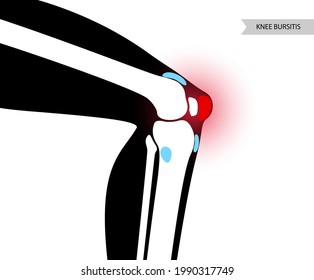 Knee bursitis inflammation. Inflamed bursa in human leg. Patella, kneecap disease, pain and deformity. Diagnosis and injection treatment. Anatomical musculoskeletal poster, medical vector illustration