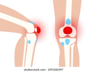 Knee bursitis inflammation. Inflamed bursa in human leg. Patella, kneecap disease, pain and deformity. Diagnosis and injection treatment. Anatomical musculoskeletal poster, medical vector illustration