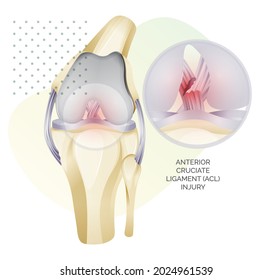 Knee Cartilage Anatomy - ACL Injury - Illustration As EPS 10 File