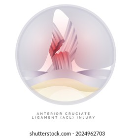 Knee Cartilage Anatomy - ACL Injury - Illustration As EPS 10 File