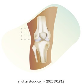 Knee Cartilage Injury - Illustration as EPS 10 File