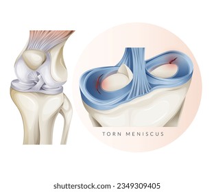 Knee Cartilage Injury - Torn Meniscus - Stock Illustration as EPS 10 File