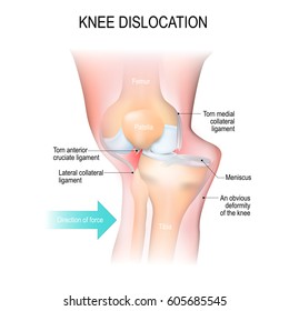 dislocated knee injury