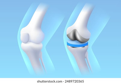 Knee implant, X-ray of the leg, 3D visualization. Vector illustration