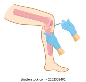 Knee injection inflammation redness vector illustration recovery. Knee injection concept. DIsease of osteoporosis arthritis, pain inflammation, joint problems in the legs. Medical poster flat.