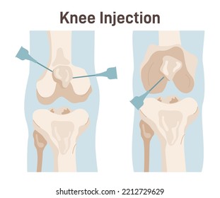 Knee Injection. Joint Treatment, Injection With Corticosteroid, Or Hyaluronic Acid. Platelet-rich Plasma Or Placental Tissue Matrix Injections. Flat Vector Illustration