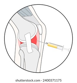 Knee injection. Stylized pictogram for web design, or mobile app about prp biotechnology, Hyaluronic acid injection, or medical procedure for osteoarthritis treatment. Regenerative medicine