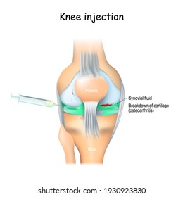 Knee Injections. treatment of joint Pain. knee and syringe with Corticosteroid, or Hyaluronic acid. Platelet-rich plasma (PRP) or Placental tissue matrix (PTM) injections 