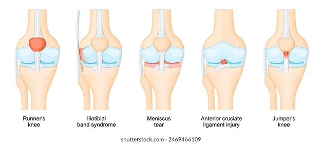 Lesiones en la rodilla. Anatomía de la articulación humana de la rodilla. Lesión del ligamento cruzado anterior, rodilla de Saltador y Corredor, tendinitis rotuliana, desgarro de menisco, síndrome de banda iliotibial. Ilustración vectorial.