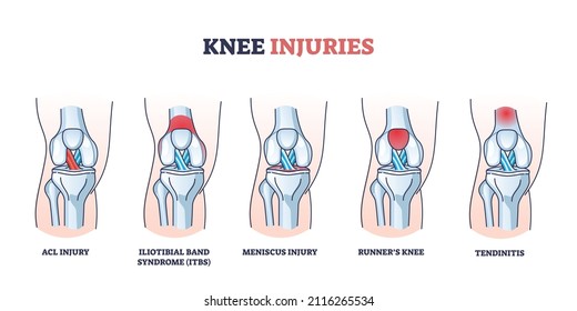 Knee injuries with medical bone, ligament or muscle trauma outline diagram. Labeled educational inflammation disease collection vector illustration. ACL injury, meniscus, runners or tendinitis example