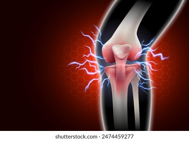 Articulación de la rodilla y fascitis Hay dolor de rodilla y dolor pulsátil en los huesos. Enfermedad inflamatoria de la articulación de la rodilla sobre fondo negro, halo naranja. Archivo de Vector 3D realista.