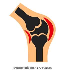 Knee joint inflammation on a white background, sign for design, vector illustration