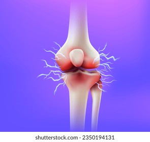 Dolor de articulaciones de rodilla y problemas de tendón. enfermedad inflamatoria del concepto de articulación de la rodilla. 3d archivo vectorial realista.