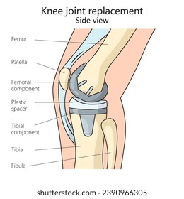 knee joint replacement structure diagram hand drawn schematic vector illustration. Medical science educational illustration