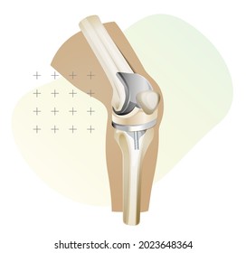 Knee Joint Replacement Surgery - Illustration as EPS 10 File