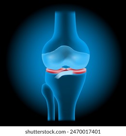 Kniemeniskusverletzungen. In: Knee Joint Anatomy. Realistisches transparentes blaues Gelenk mit leuchtender Wirkung auf dunklem Hintergrund. Vektorillustration wie Röntgen-Bild für das Gesundheitsdesign. Meniskusriss.