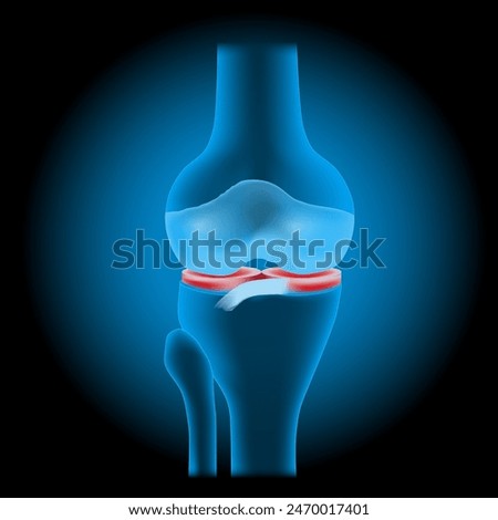 Knee meniscus injuries. Knee joint anatomy. Realistic transparent blue joint with glowing effect on dark background. vector illustration like X-ray image for healthcare design. Meniscal tear.