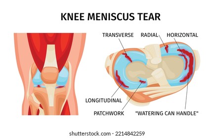 Knee meniscus tear anatomy diagram realistic infographics on white background vector illustration