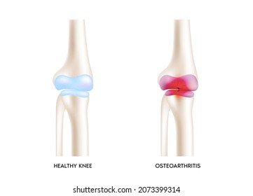 Knee osteoarthritis. Arthritis or degenerative joint disease. Cartilage becomes worn. Results in inflammation swelling. Medical healthcare concept. Isolated on white background. Realistic 3d Vector.