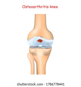 Knee Osteoarthritis. Arthritis Or Joint Pain. Degenerative Joint Disease. Realistic Vector Illustration