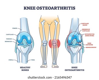 Knee osteoarthritis condition with skeletal bone degeneration outline diagram. Labeled educational scheme with medical orthopedic disease vector illustration. Injury comparison with healthy leg bones.