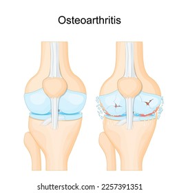 Knee osteoarthritis. degenerative joint disease.