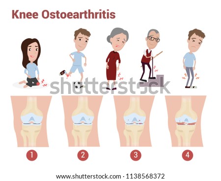 Knee Osteoarthritis infographic to explain about pain, knee pain, joint pain which happen in adult and elder health