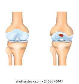 Osteoarthritis des Knies. Gelenkdegeneration. Vektorillustration.