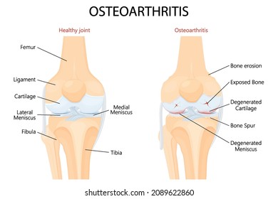 Knee Osteoarthritis and normal joint detailed anatomy. Osteoarthritis. Arthritis or pain within a joint. degenerative joint disease. Cartilage becomes worn. Vector flat design