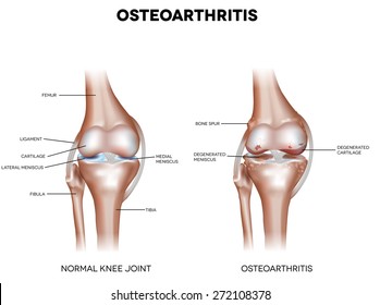 térd osteoarthritis