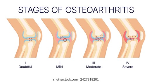 Stadien der Kniearthrose, Anatomie der menschlichen Kniegelenke und Knochen. Vektor medizinisches Diagramm der Arthritis Krankheit Stadien mit gesunden und verletzten Knorpeln, arthritische Entzündung, Medizin Themen