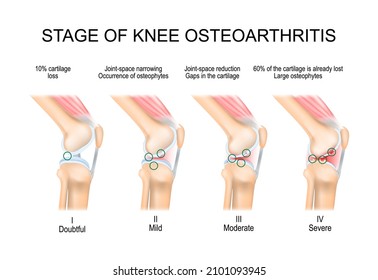 knee Osteoarthritis. Stages of OA. Kellgren and Lawrence criteria for assessment stage of osteoarthritis. The classifications are based on osteophyte formation and joint space narrowing. side view