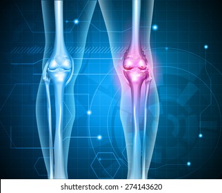 Knee pain abstract background. Healthy joint and unhealthy painful joint with osteoarthritis. 