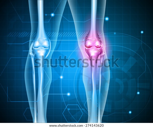 膝盖疼痛抽象背景 健康的关节和不健康的痛苦关节与骨关节炎 库存矢量图 免版税