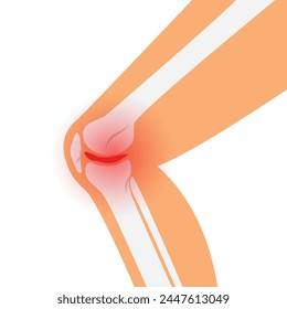 Knee pain, illustration of the knee in section, bones and joints. The concept of knee injury. 