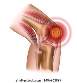 Knee Pain. Injury To The Leg, Patella, Knee Joint. Vector Illustration Isolated On A White Background.