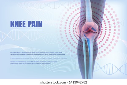 Alivio del dolor de rodilla, huesos de rodilla