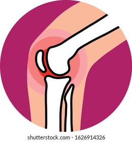 Knee pain x ray. arthritis joint pain flat illustration,vector isolated