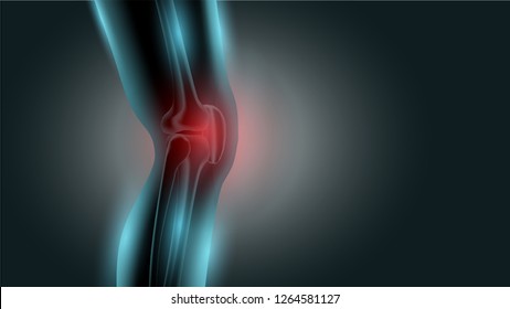 Knee pain x ray. Healthy joint and unhealthy painful joint with osteoarthritis.