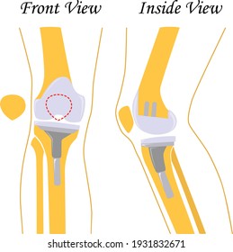 Sustitución de rodilla. Prótesis articulares. Endoprótesis de rodilla. Ilustración vectorial. Diseño plano