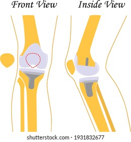 Knee replacement. Joint prosthetics. Knee endoprosthesis. Vector illustration. Flat design