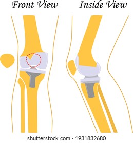 Knee replacement. Joint prosthetics. Knee endoprosthesis. Vector illustration. Flat design