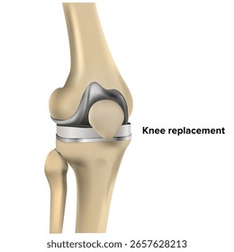 Kniegelenksersatz, Knieschmerzen und Kniechirurgie Konzept medizinische Illustration