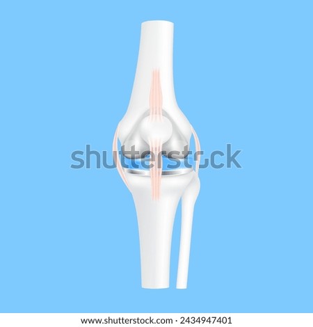 Knee replacement surgery total or implant for treatment relieve arthritis, after joint damaged. Leg bone and cartilage ligament. Innovation medical technology treatment. 3D realistic vector EPS10.